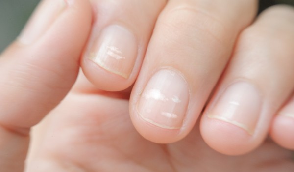 6 фактов, которые ногти говорят о вашем здоровье