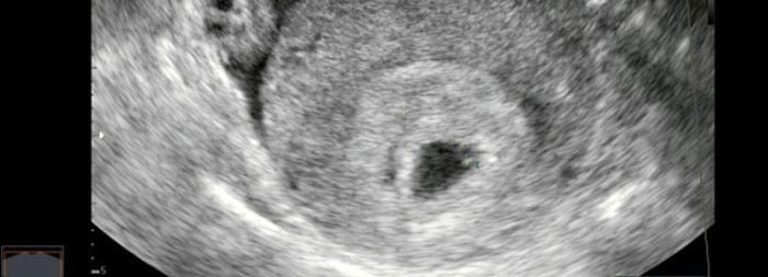 Снимок УЗИ плода на четвёртой неделе беременности