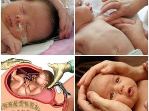 Причины тремора - патологии у новорожденных