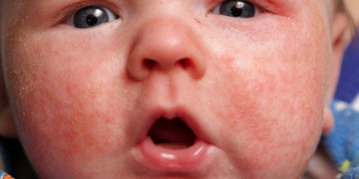 Аллергическая сыпь на лице у новорожденного