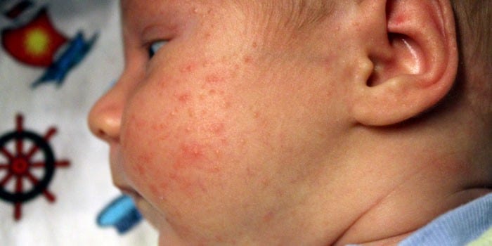 Проявление аллергической сыпи на щеках у грудного ребенка