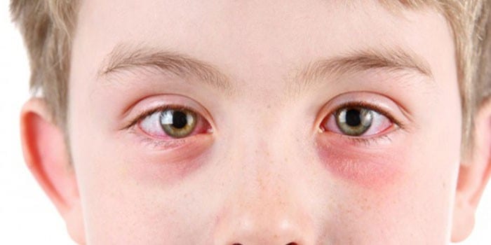 Проявления конъюнктивита на глазах ребенка