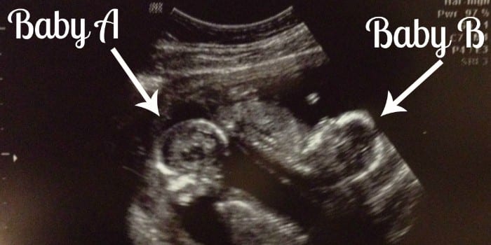 Многоплодная беременность на УЗИ снимке