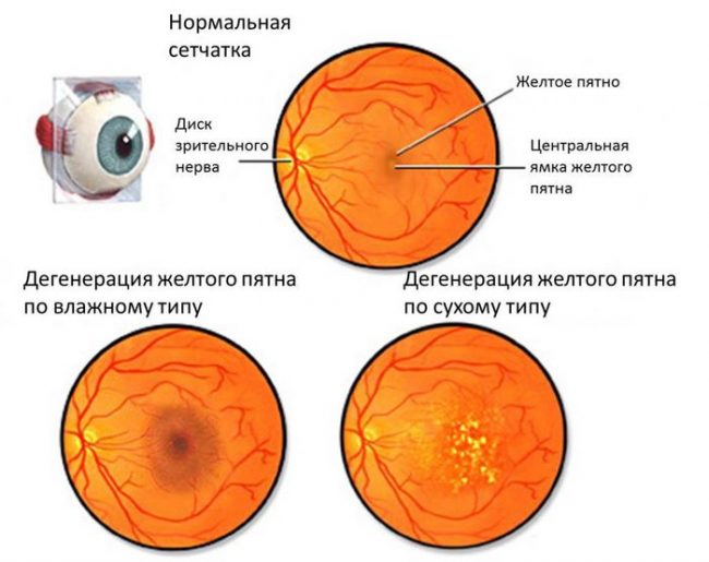 Возрастная макулярная дегенерация