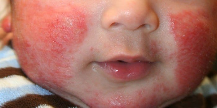 Проявление диатеза на щеках у ребенка