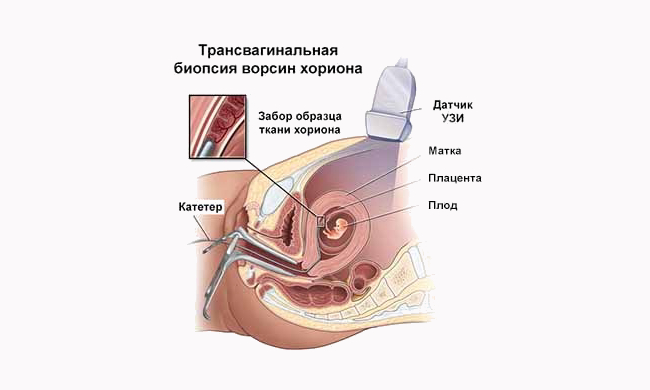Схема проведения биопсии ворсин хориона