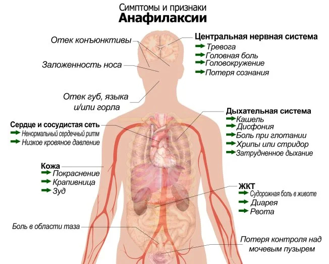 Симптомы и признаки анафилаксии