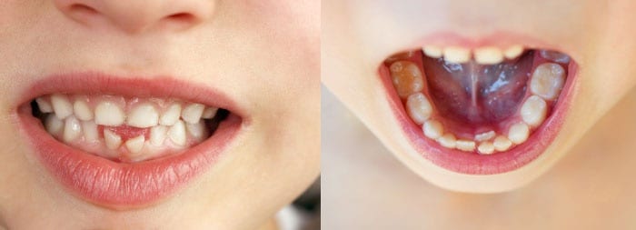 Аномальное развитие зубов