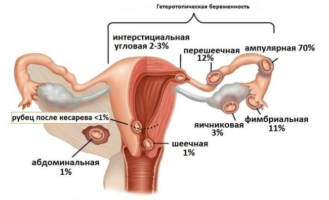 Гетеротопическая беременность