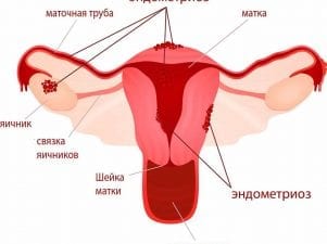 Проявление эндометриоза