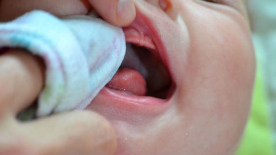 Обработка ротовой полости малыша при кандидозе
