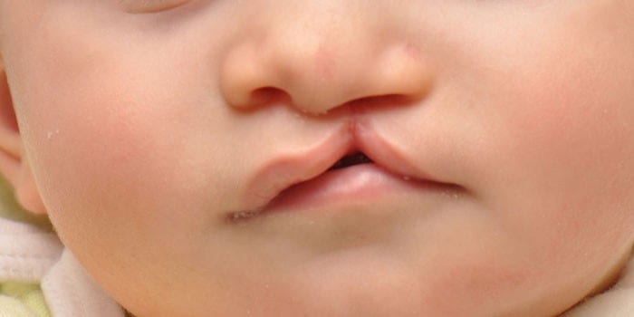 Заячья губа у грудного ребенка