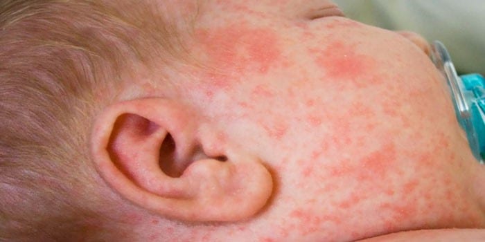 Аллергическая сыпь на лице у грудного ребенка