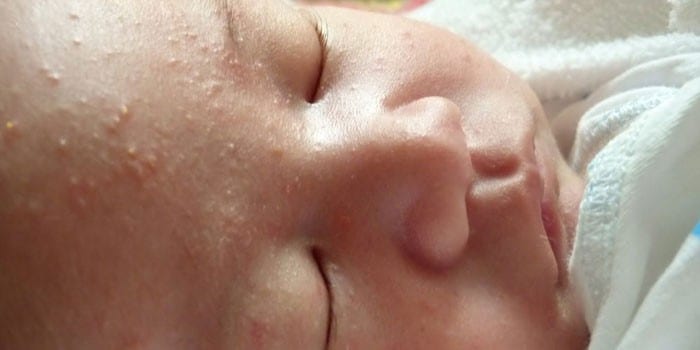 Акне на коже лица у новорожденного ребенка