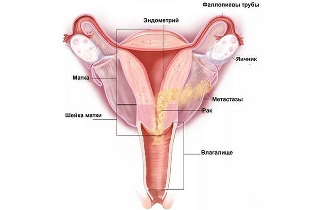 Рак женских половых органов на схеме