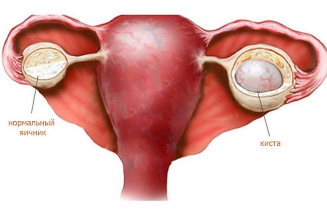 Эндометриоидная киста яичника