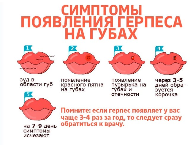 Симптомы появления герпеса на губе