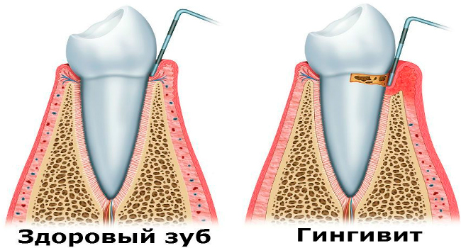 Здоровый зуб и пораженный гингивитом
