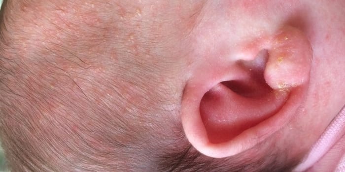 Корочке на ухе у малыша