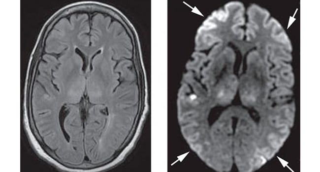 МРТ мозга новорожденного с ПЭП