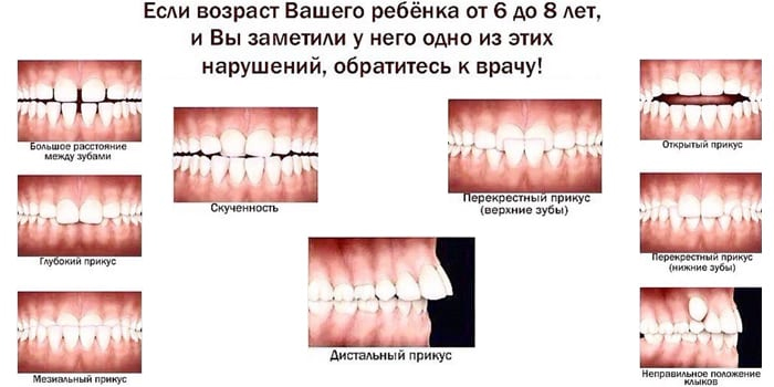 Отклонения в формировании зубного ряда