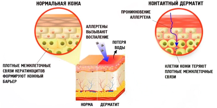 Нормальная кожа и контактный дерматит