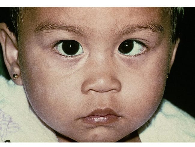 Синдром ленивого глаза у ребенка