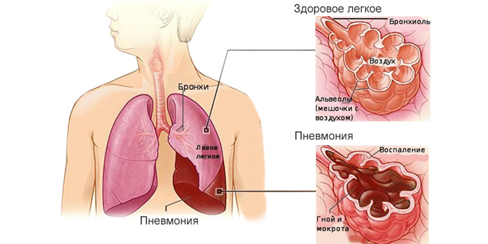 Здоровое легкое и пневмония