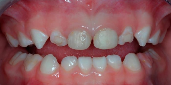 Разрушение передних зубов
