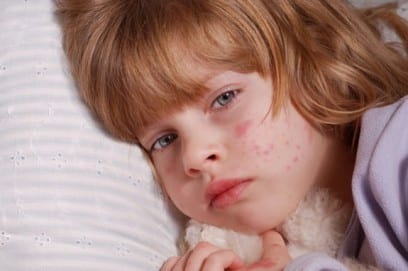 Розеола детская: симптомы и лечение заболевания