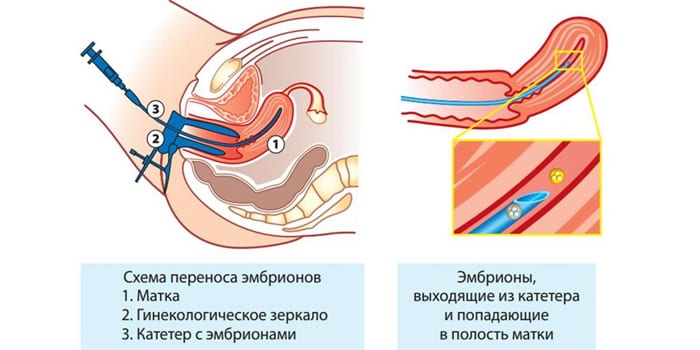 Схема переноса эмбриона