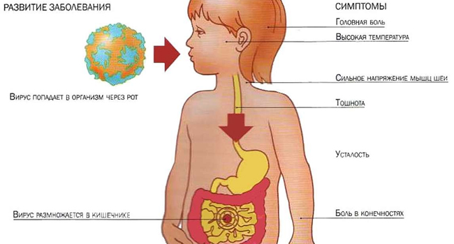 Симптомы ротавирусной инфекции