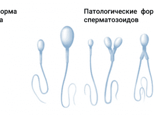 Слабая подвижность сперматозоидов