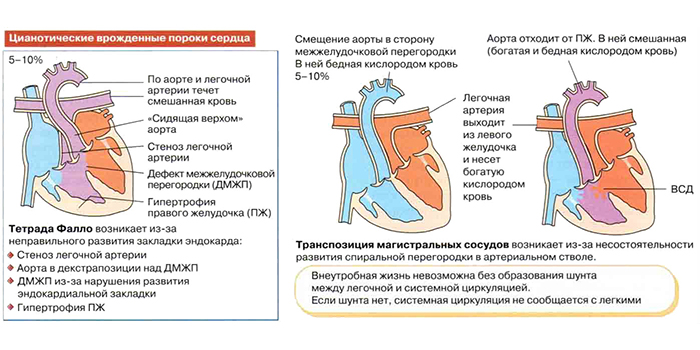 Цианотические врожденные пороки сердца