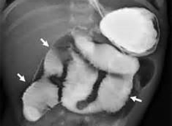 Рентгеновский снимок кишечника