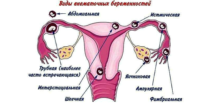 Виды внематочных беременностей