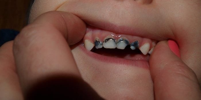 Зубы ребенка после серебрения