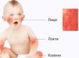 5 признаков того, что у вашего ребенка аллергия