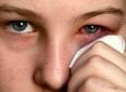 5 вещей, которые вы не знали об аллергии на глазах