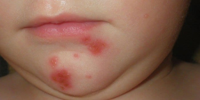Проявление стрептодермии на коже у ребенка