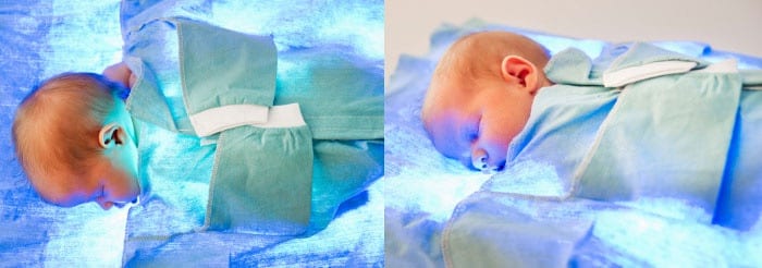Новорожденный с желтухой во время фототерапии