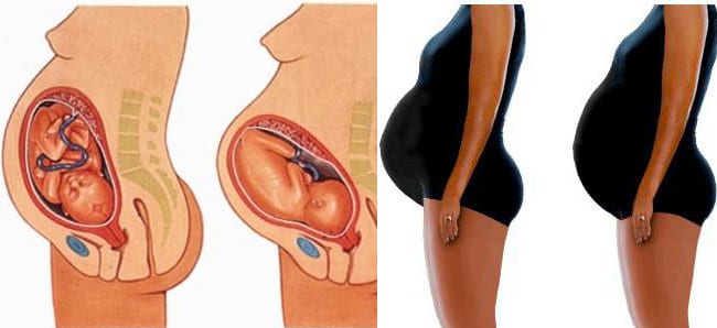 Признаки опущенного живота у беременной. Что происходит, когда опускается живот у беременных. Признаки, свидетельствующие об опущении живота