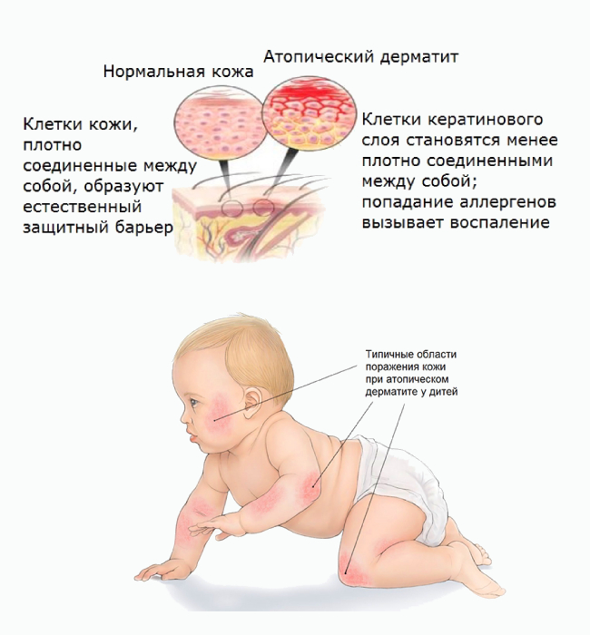 Атопич. Атопический дерматит у 9 месячного ребенка. Атопический дерматит причины у ребенка 1 год. Атопический дерматит причины у детей 3 месяца. Симптомы атопического дерматита у ребёнка в 10 месяцев.