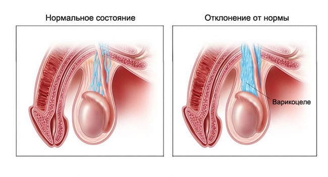 Варикоцеле