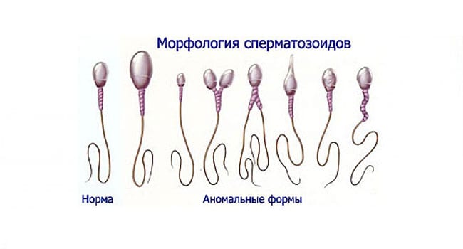 Норма и аномалии сперматозоидов