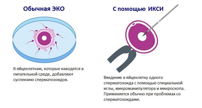 ЭКО с ИКСИ