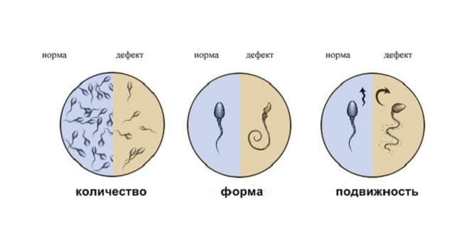 Бесплодие у мужчин