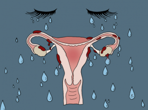 7 симптомов эндометриоза, которые должна знать каждая женщина