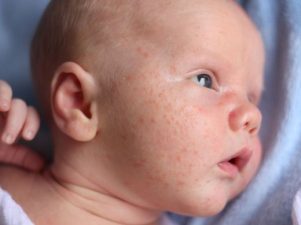 Что нужно знать о сыпи у младенцев