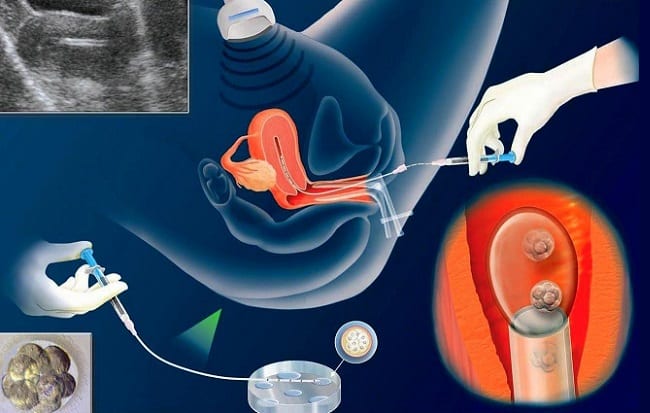 Подсадка эмбрионов в полость матки